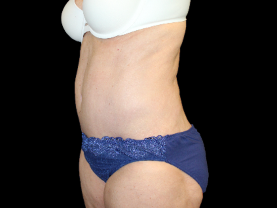 Tummy Tuck: Case 19 - After