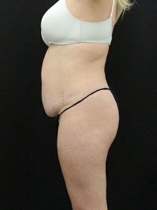Tummy Tuck Case 21 - Before