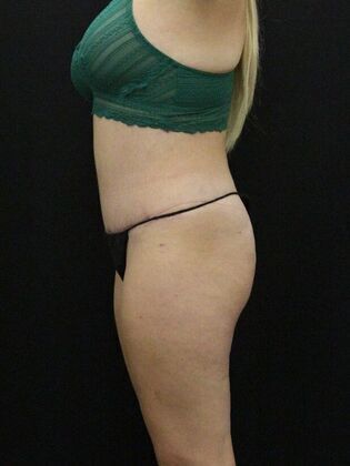 Tummy Tuck Case 21 - After