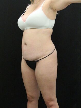 Tummy Tuck: Case 21 - Before