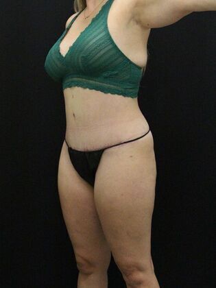 Tummy Tuck: Case 21 - After