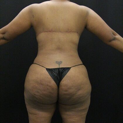 Body Lift Case 1 - After