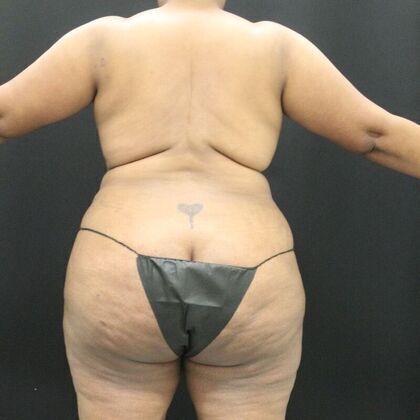 Body Lift Case 1 - Before