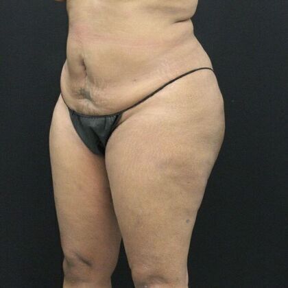 Body Lift: Case 1 - Before