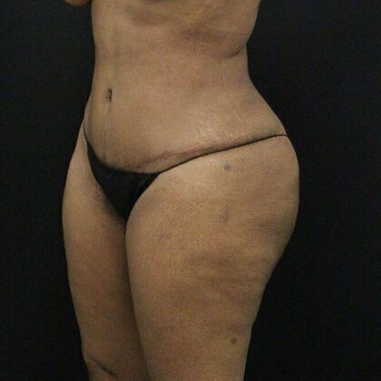 Body Lift: Case 1 - After