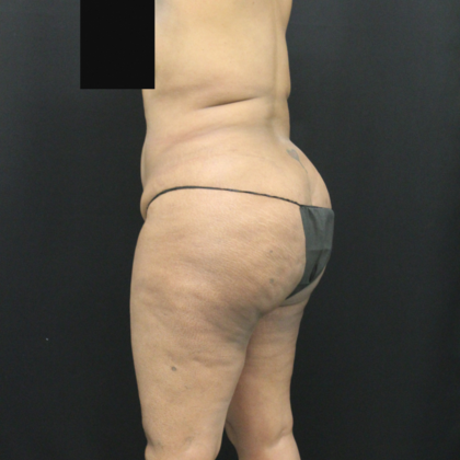 Body Lift: Case 1 - Before