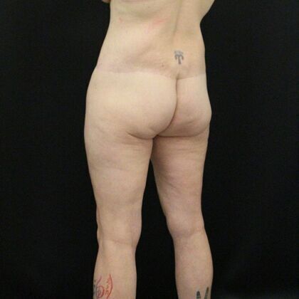 Body Lift Case 2 - After