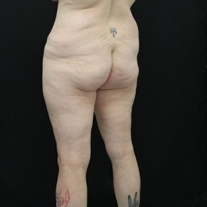 Body Lift Case 2 - Before