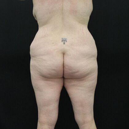 Body Lift: Case 2 - Before