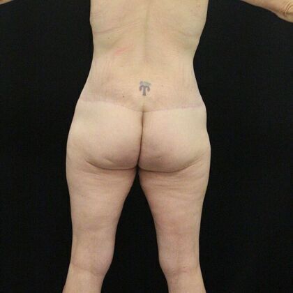 Body Lift: Case 2 - After
