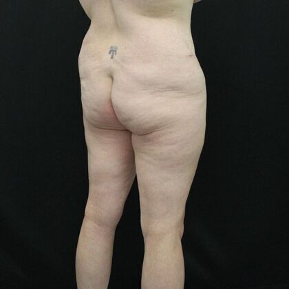 Body Lift: Case 2 - Before