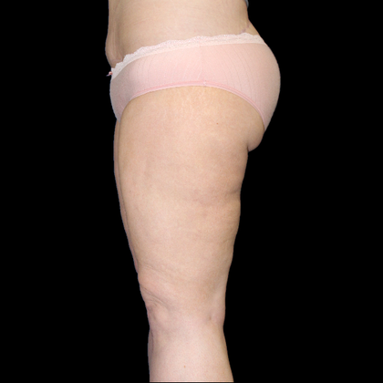Thigh Lift & Reduction Case 1 - After