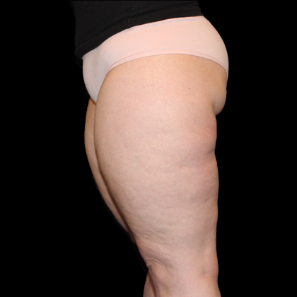 Thigh Lift & Reduction Case 1 - Before