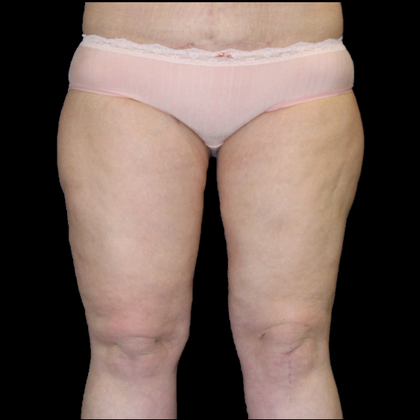 Thigh Lift & Reduction: Case 1 - After