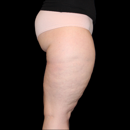 Thigh Lift & Reduction: Case 1 - Before