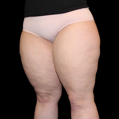 Thigh Lift & Reduction: Case 1 - Before