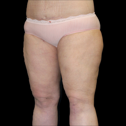 Thigh Lift & Reduction: Case 1 - After