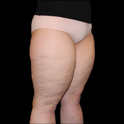 Thigh Lift & Reduction: Case 1 - Before