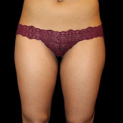 Thigh Lift & Reduction Case 2 - Before