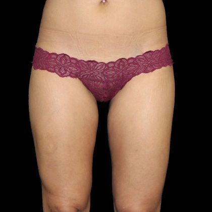 Thigh Lift & Reduction Case 2 - After