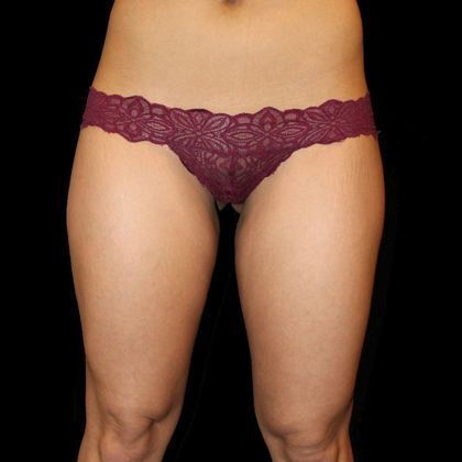 Thigh Lift & Reduction: Case 2 - Before