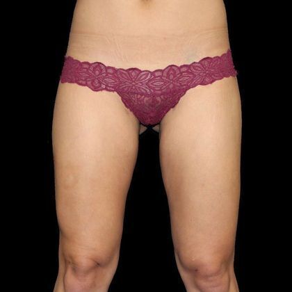 Thigh Lift & Reduction: Case 2 - After