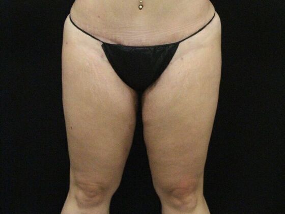 Thigh Lift & Reduction Case 3 - After