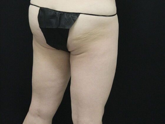 Thigh Lift & Reduction: Case 3 - Before