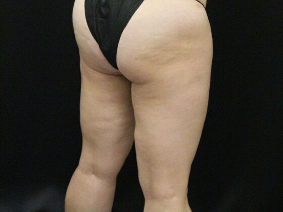 Thigh Lift & Reduction: Case 3 - After