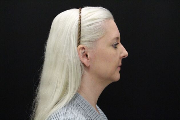 Liposuction Case 1 - Before