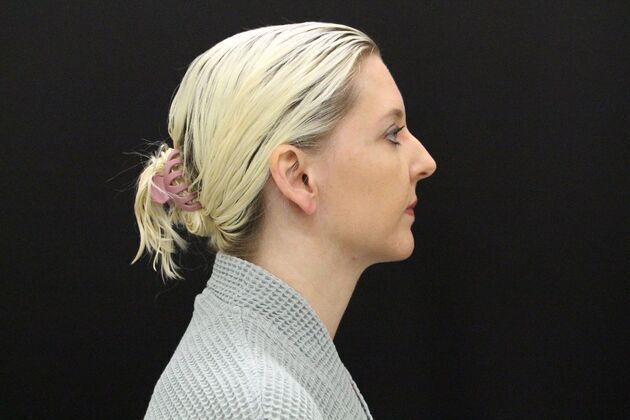 Liposuction Case 1 - After