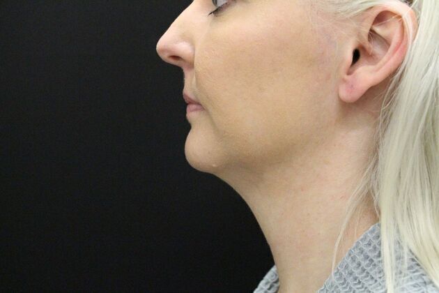 Liposuction: Case 1 - Before