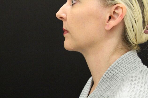 Liposuction: Case 1 - After