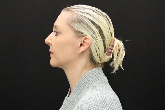 Liposuction: Case 1 - After