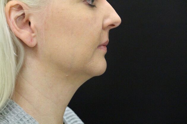 Liposuction: Case 1 - Before