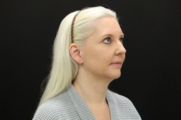 Liposuction: Case 1 - Before