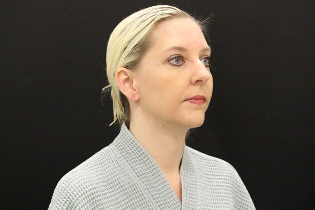 Liposuction: Case 1 - After