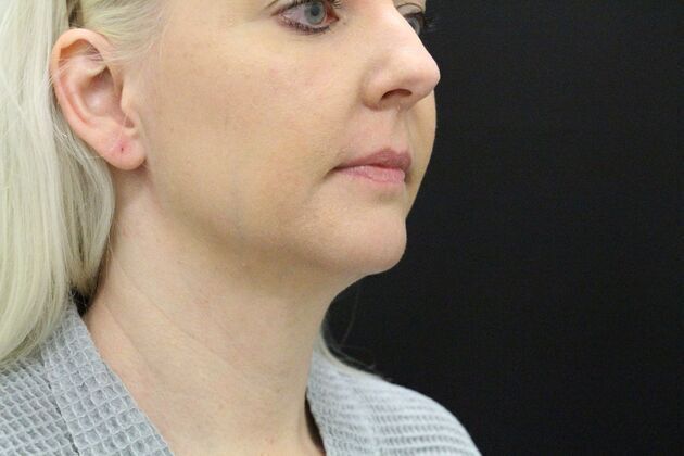 Liposuction: Case 1 - Before