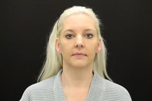 Liposuction: Case 1 - Before