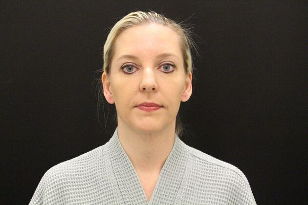 Liposuction: Case 1 - After