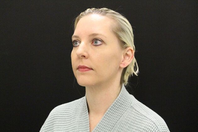 Liposuction: Case 1 - After