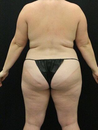 Liposuction Case 2 - Before