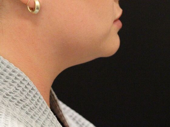 Liposuction: Case 2 - Before