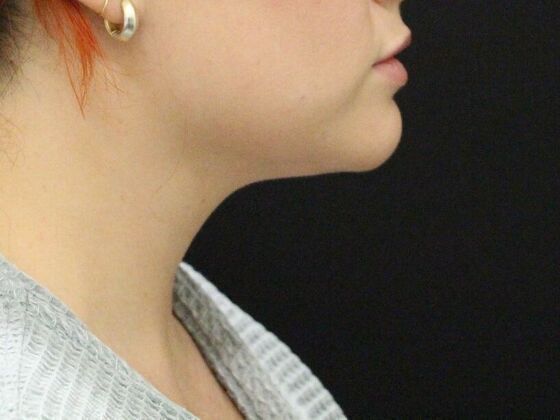 Liposuction: Case 2 - After