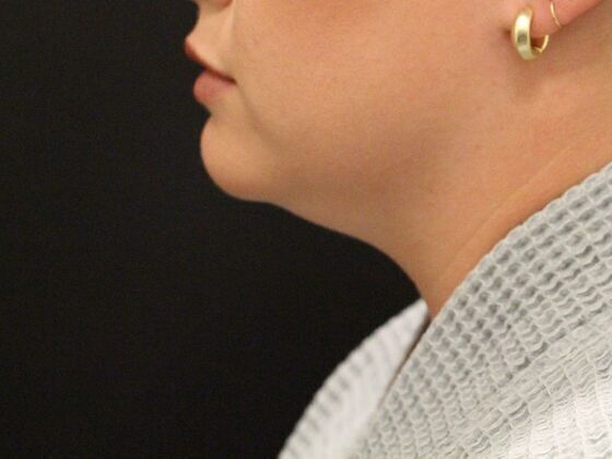 Liposuction: Case 2 - Before