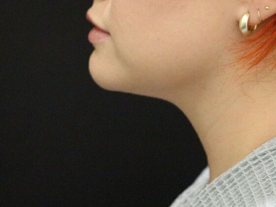 Liposuction: Case 2 - After