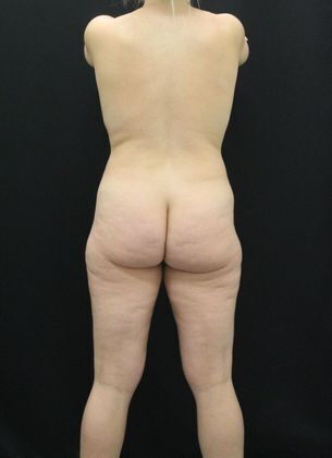 Liposuction: Case 4 - Before