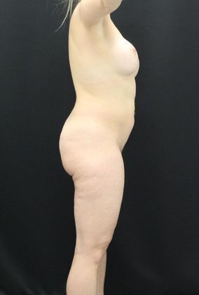 Liposuction: Case 4 - Before