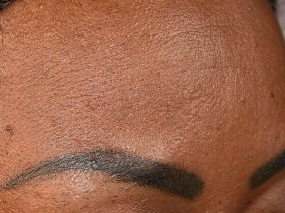 Eyebrow Transplantation: Case 1 - Before