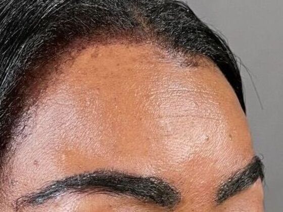 Eyebrow Transplantation: Case 1 - After